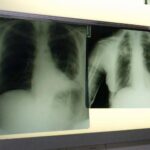 Salute, esperti: “Virus sinciziale sottovalutato nonostante oltre 50mila ricoveri l’anno”