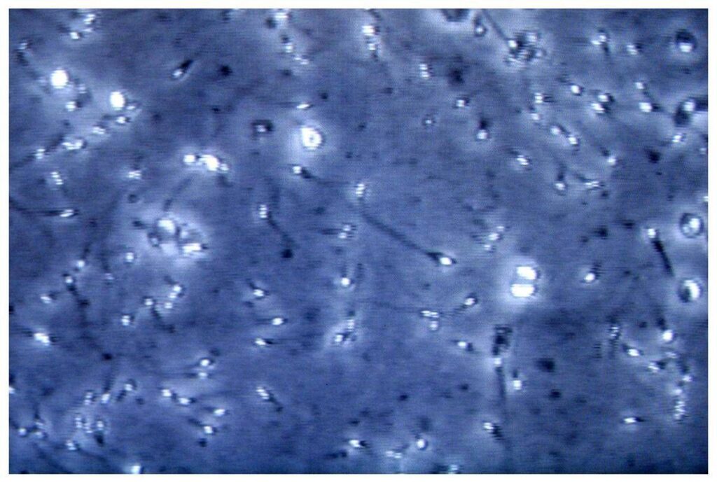 Microplastiche nella prostata e nel liquido seminale, la scoperta italiana: cosa comporta