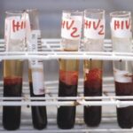 Hiv, nuovi dati su PrEP due volte l’anno e terapie Gilead all’Eacs 2025