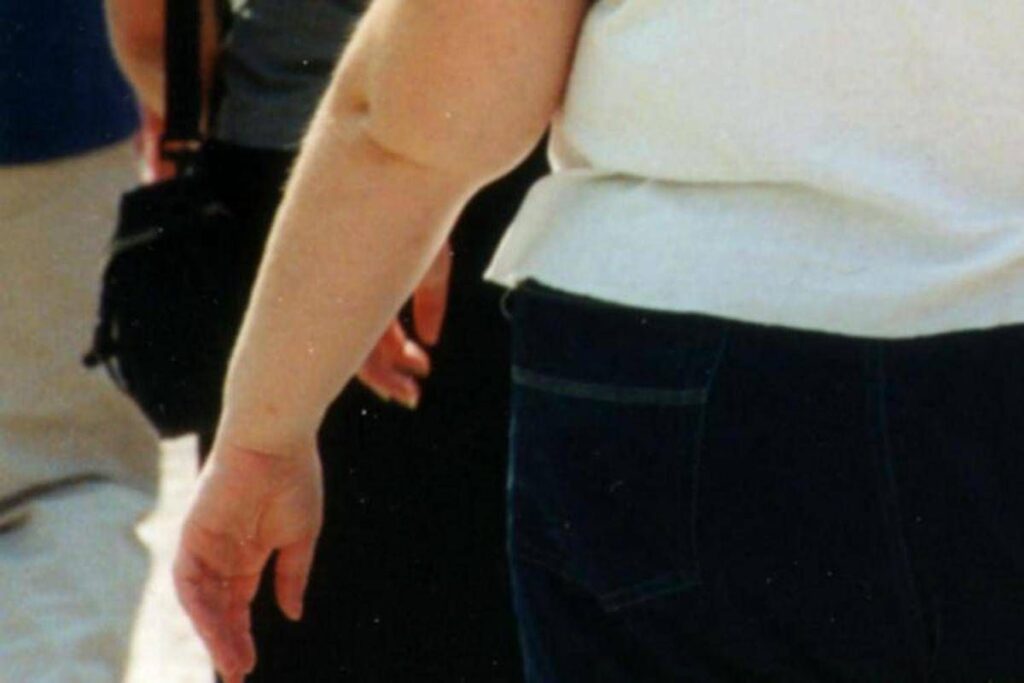 Una morte per malattie infettive su 10 è legata all’obesità, lo studio