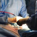 Trapianto di fegato completamente robotico, a Padova la prima mondiale con tecnica innovativa