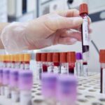 Tumore allo stomaco in stadio precoce, con immunoterapia 69% pazienti vivo a 3 anni