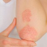 Giornata psoriasi, Ucb rinnova l’impegno contro lo stigma