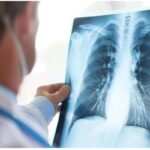 Tumore al polmone a piccole cellule in stadio esteso, ok Aifa a primo anti Pd-1 in prima linea