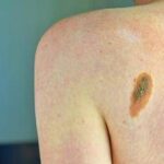 Prevenzione melanoma, Sidemast pronta a collaborare per percorsi chiari