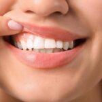 Denti a rischio tra i giovani, Sidp: “Il 36% della Gen Z ha gengive che sanguinano”