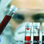 Alzheimer, allo studio esame del sangue per aiutare diagnosi precoce