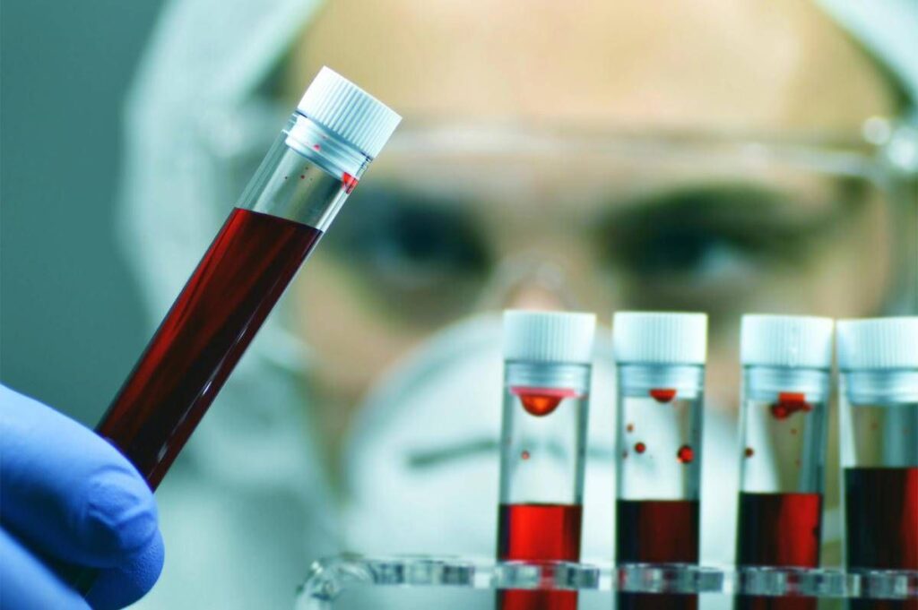 Giornata patologie eosinofile, ematologa Iurlo ‘fino a 5 anni per diagnosi’