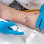 Idrosadenite suppurativa, le iniziative di Ucb per migliorare diagnosi e cura