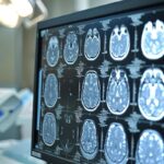 Neoplasie cerebrali, in Italia ogni anno 3mila casi di glioma