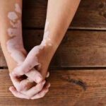 Estate, vitiligine e sole: le regole per una abbronzatura sicura