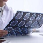 Giornata Sla, neurologi: “Non resti confinata alla sperimentazione”