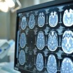 Giornata mondiale dell’Alzheimer, neurologi: “Ora percorsi cura più efficaci e sostenibili”