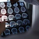 Nuove molecole e bersagli, così si evolve la terapia contro l’Alzheimer: il punto