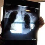 Tumore al polmone, con terapia mirata più chemio sopravvivenza globale di quasi 4 anni
