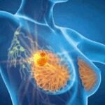 Cancro seno, con profilazione molecolare e terapie target migliori prospettive di cura