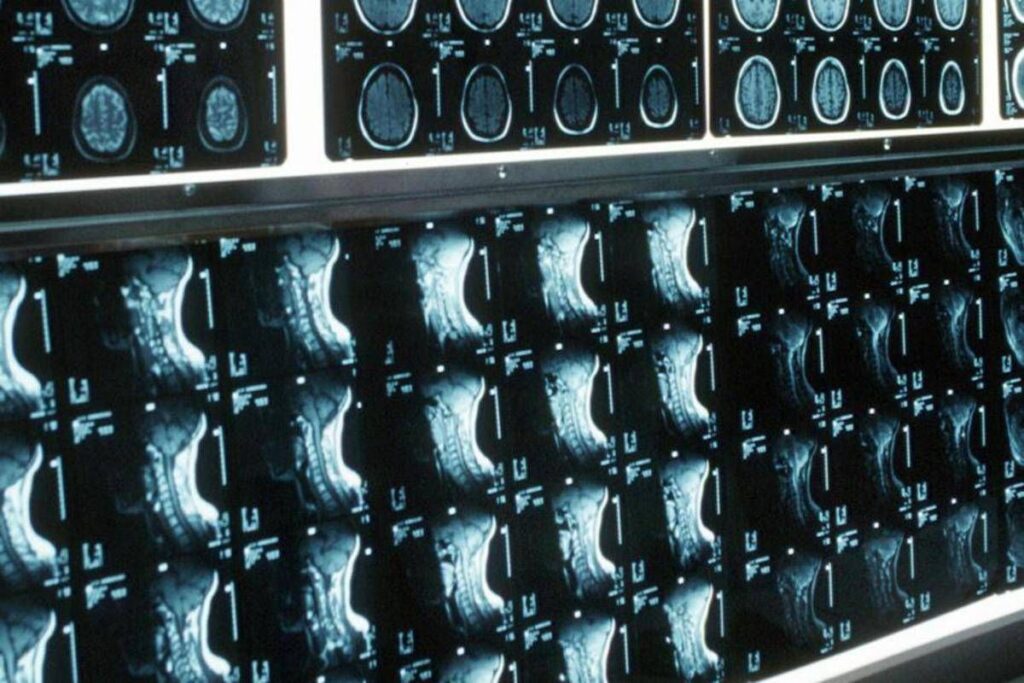 Ipofosfatemia legata all’X, primo bilancio e prospettive su linee guida