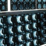 Ipofosfatemia legata all’X, primo bilancio e prospettive su linee guida