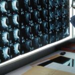 Oltre 500 malattie rare delle ossa, esperti: “Investire in prevenzione e diagnosi”