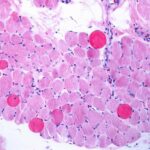 Malattie rare, risultati positivi a 5 anni per vamorolone in distrofia Duchenne