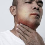 Angioedema ereditario, ok Ue a prima terapia preventiva mirata all’Rna