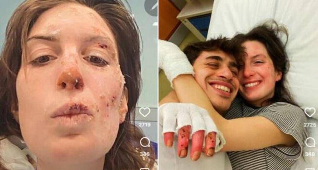 Crans-Montana, oggi dimessi due ragazzi. Eleonora Palmieri mostra le ustioni sui social