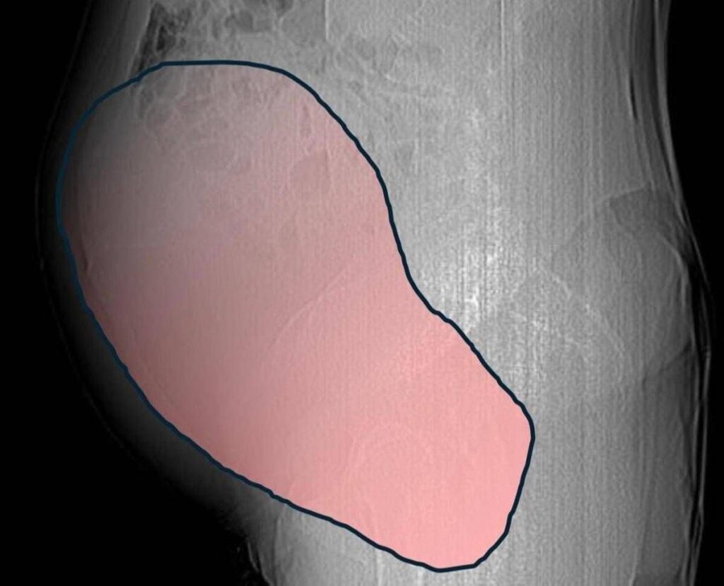 Intervento record al Sant’Anna di Torino, rimosso tumore ovarico di 6 kg