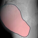 Intervento record al Sant’Anna di Torino, rimosso tumore ovarico di 6 kg