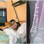 Thais Wiggers, operazione alla caviglia dopo incidente: “Comincio anno con un piede bionico”