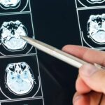 Ecco come il Long Covid cambia il cervello con meccanismi tipici dell’Alzheimer