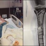 Milano Cortina, Vonn mostra la gamba dopo le operazioni: “Dolore difficile da gestire”