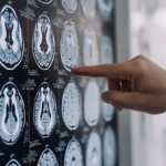 Parkinson, ansia e depressione possono essere segnali precoci: lo studio