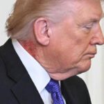 Trump e il collo arrossato, la foto riaccende i dubbi sulla salute del presidente