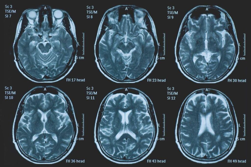 Una persona su 3 ha un disturbo neurologico, a Napoli arriva BrainSpace House
