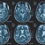 Una persona su 3 ha un disturbo neurologico, a Napoli arriva BrainSpace House