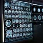 Uno spray nasale ferma l’invecchiamento del cervello, lo studio