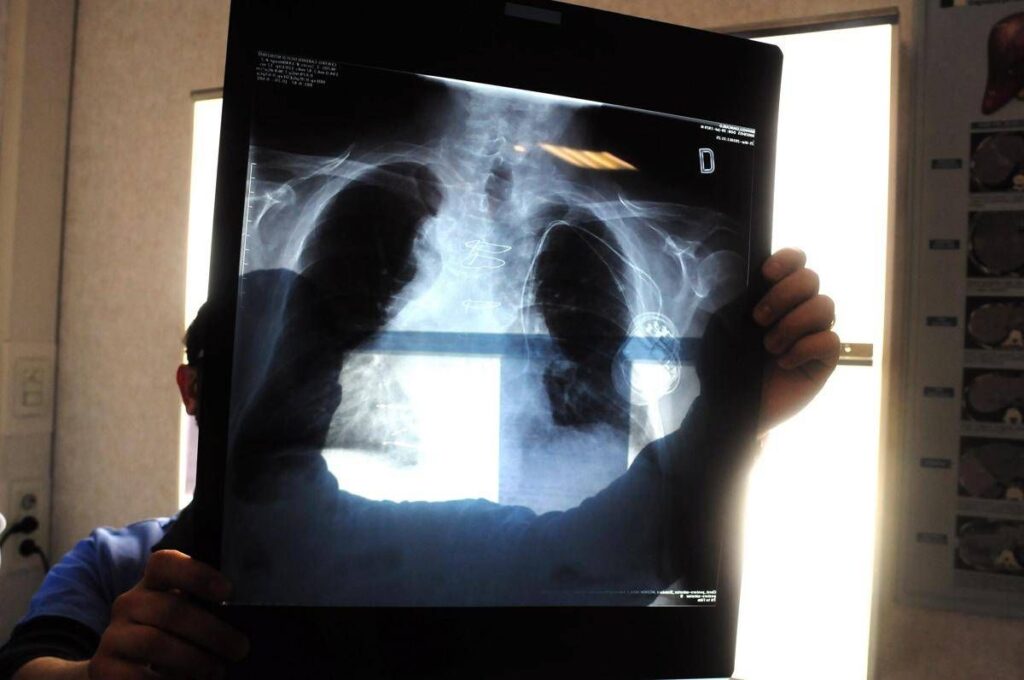 Sirm: “Ai strumento anti liste d’attesa, 50% esami imaging per over70 non necessario”