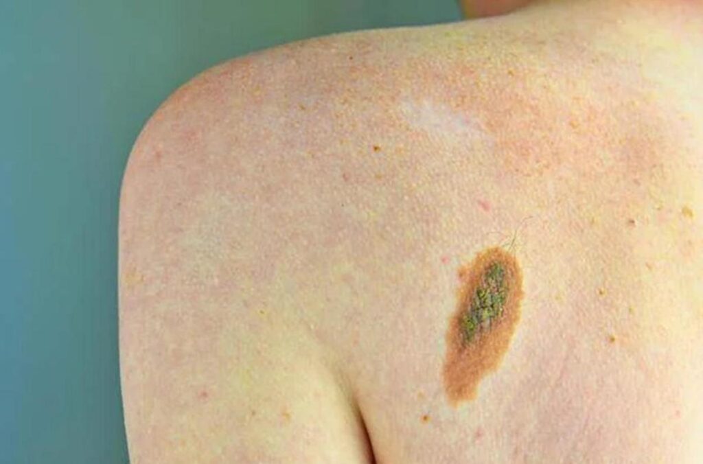 Imi: “Bene legge su prevenzione melanoma, educare i giovani su rischi”