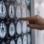 Malattia di Parkinson, ok in Europa a formulazione orale Ld/Cd a rilascio modificato