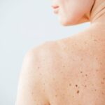 Nei e sole, Sidemast lancia la Giornata della prevenzione dermatologica
