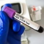 Tumore gastroesofageo Her2+, risultati positivi per tislelizumab con zanidatamab e chemio