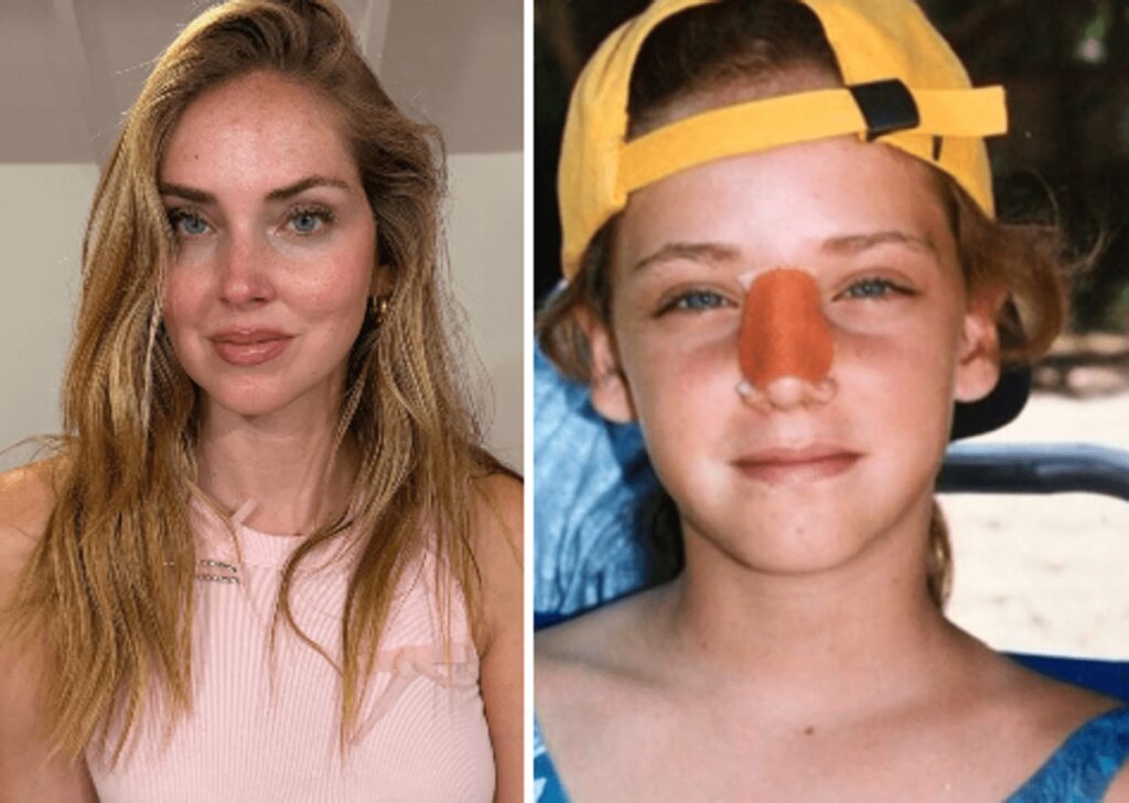 Chiara Ferragni, l’intervento al naso: “Ecco perché è storto ora”