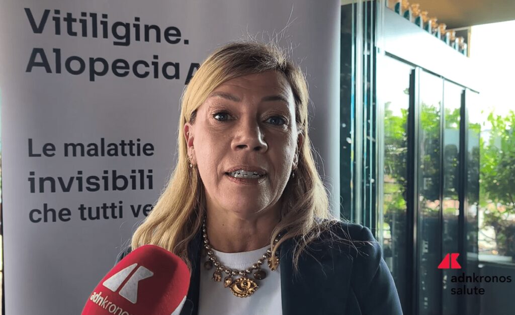 Cordella (AbbVie): “Vitiligine e alopecia siano riconosciute da Ssn”