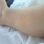 Dermatite atopica, Aifa estende rimborso di upadacitinib dai 12 anni di età