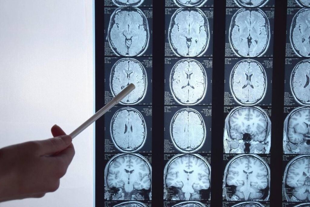 Di Battista e il tumore al cervello, in Italia circa 6mila diagnosi ogni anno: quali sono i sintomi ‘spia’