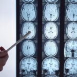 Di Battista e il tumore al cervello, in Italia circa 6mila diagnosi ogni anno: quali sono i sintomi ‘spia’