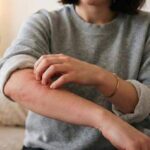 Malattia della pioggia, perché se ne parla: cos’è e sintomi