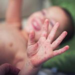 Morbillo, aumentano casi e ricoveri. Bassetti: “In Liguria focolaio senza precedenti, l’Italia rischia gravissima epidemia”