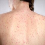 Morbillo, è allarme negli Usa. Italia prima per casi in Europa in in primi 6 mesi 2026