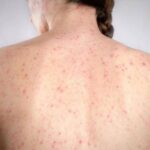 Morbillo, l’allarme dell’infettivologo Andreoni: “Casi in crescita, ricoveri frequenti negli adulti”